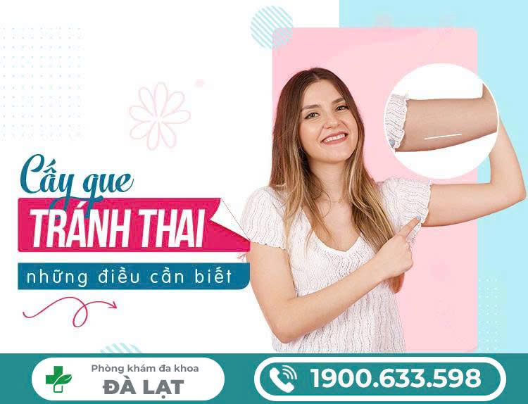 NÊN CẤY QUE TRÁNH THAI HAY ĐẶT VÒNG?